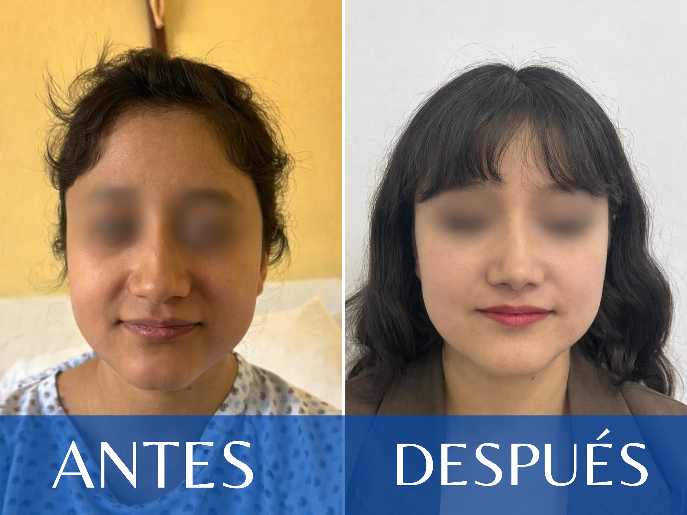 Rinoplastia antes y después - Caso 1