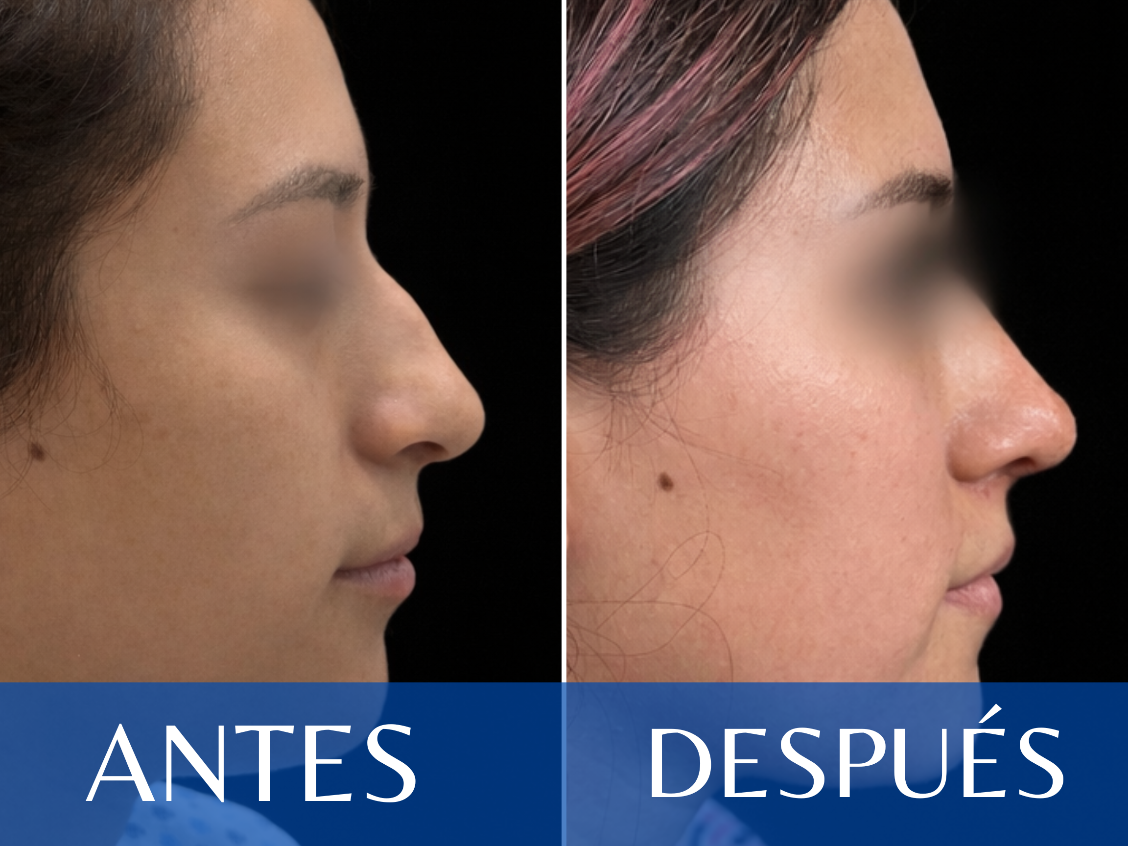 Rinoplastia antes y después - Caso 10