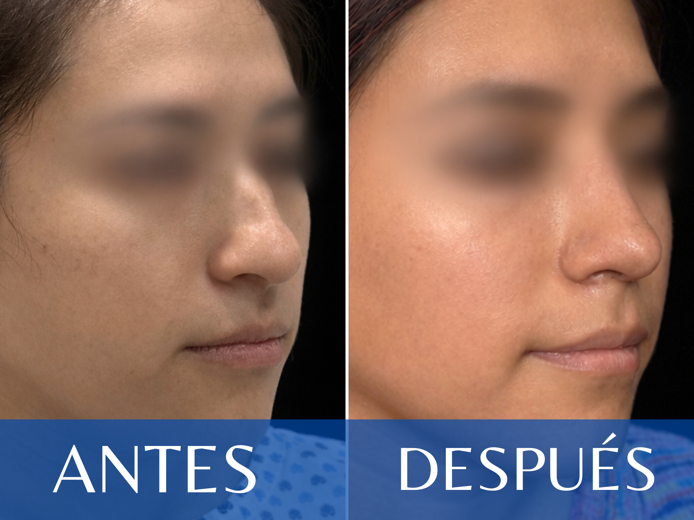 Rinoplastia antes y después - Caso 11
