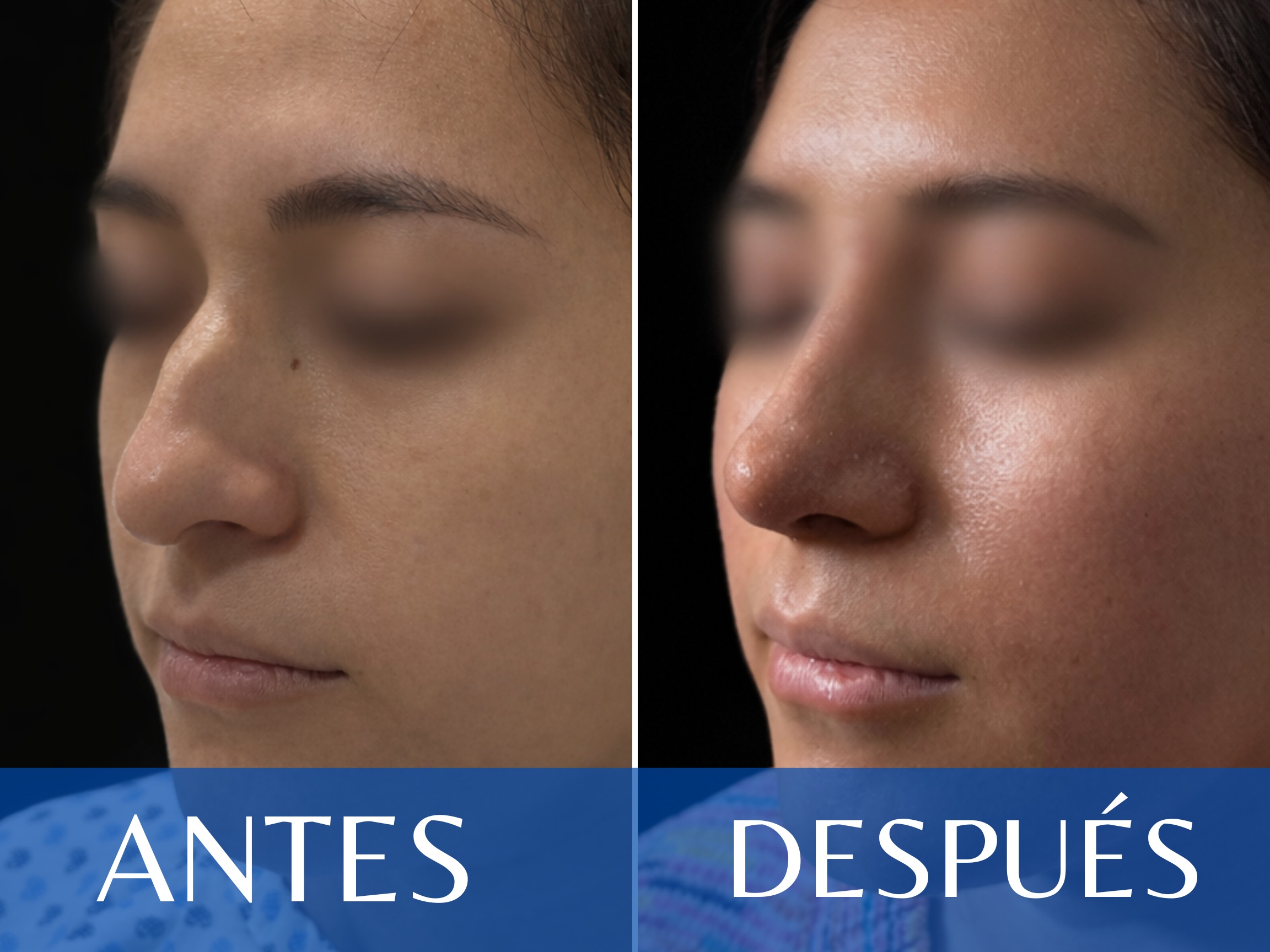 Rinoplastia antes y después - Caso 13