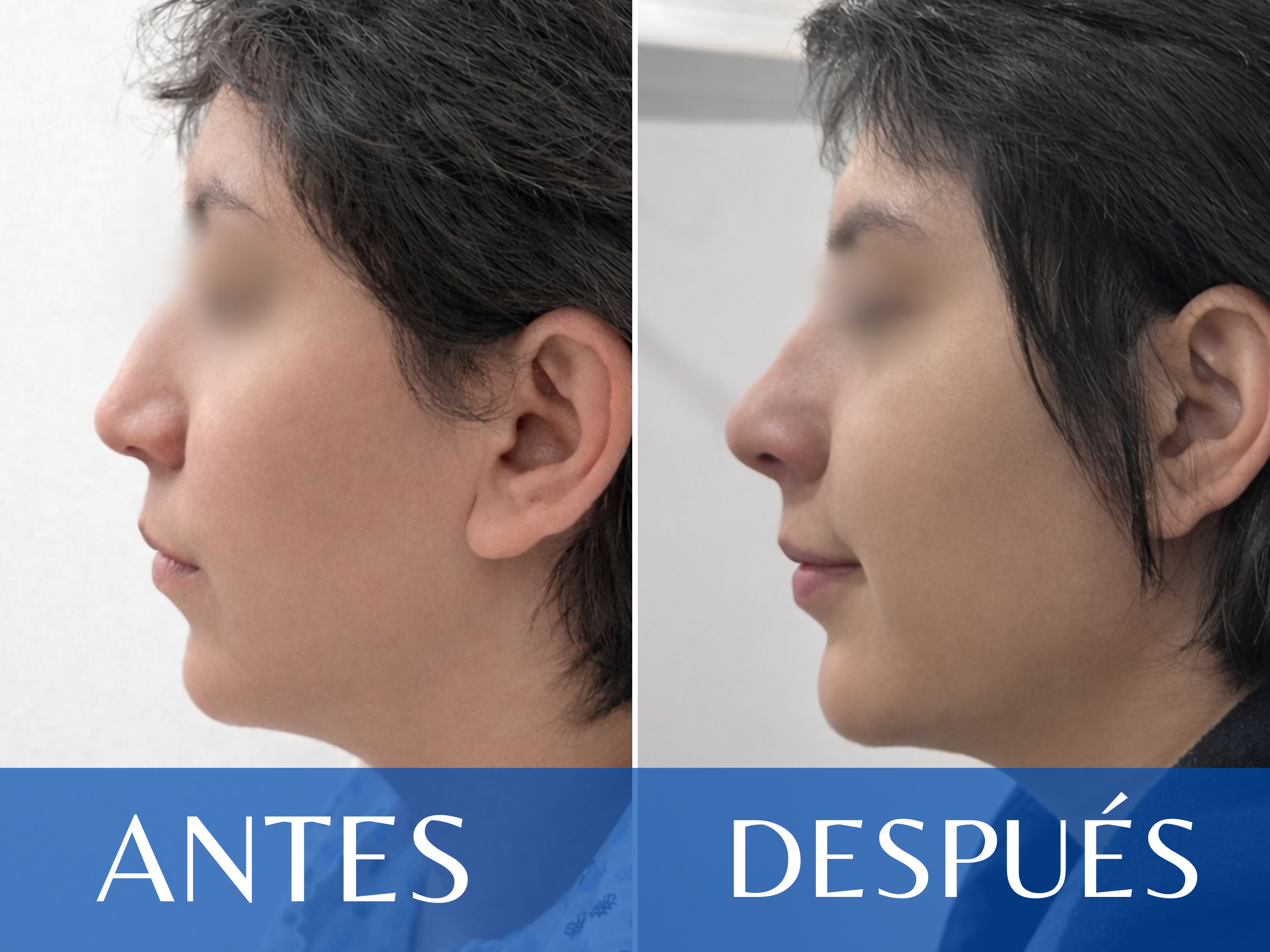 Rinoplastia antes y después - Caso 14