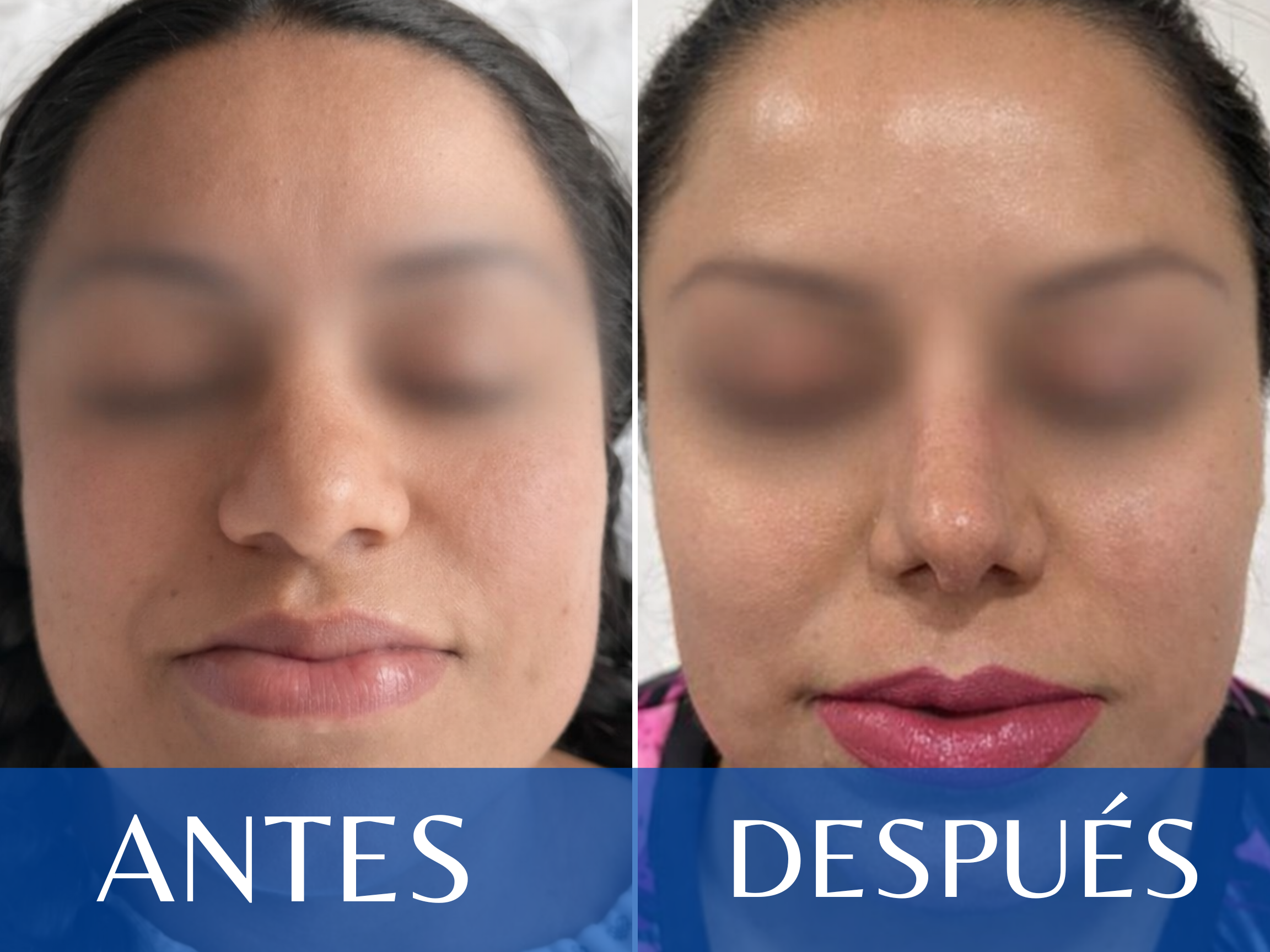 Rinoplastia antes y después - Caso 15