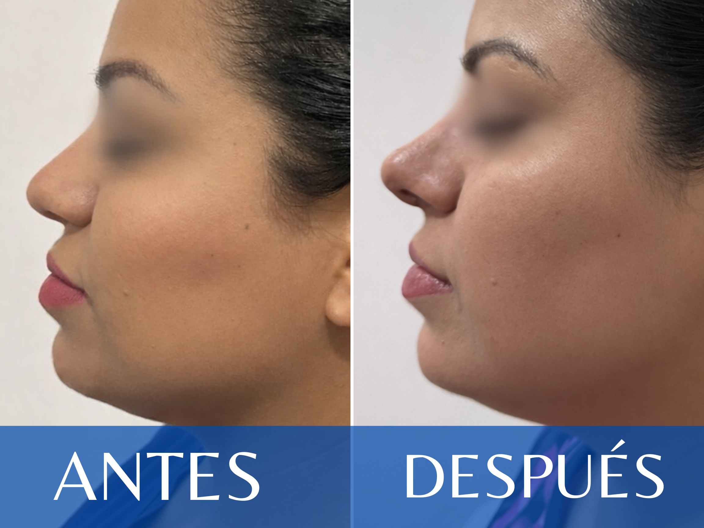 Rinoplastia antes y después - Caso 16