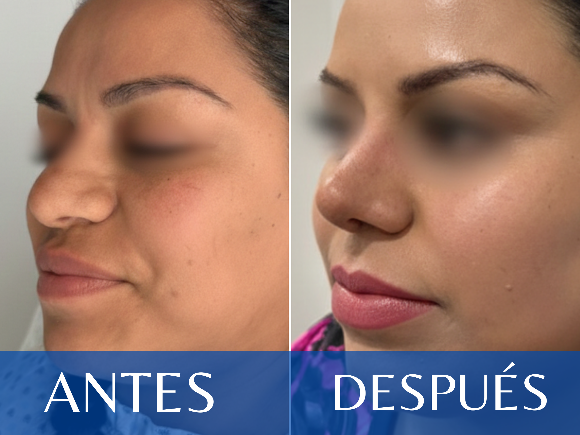 Rinoplastia antes y después - Caso 17