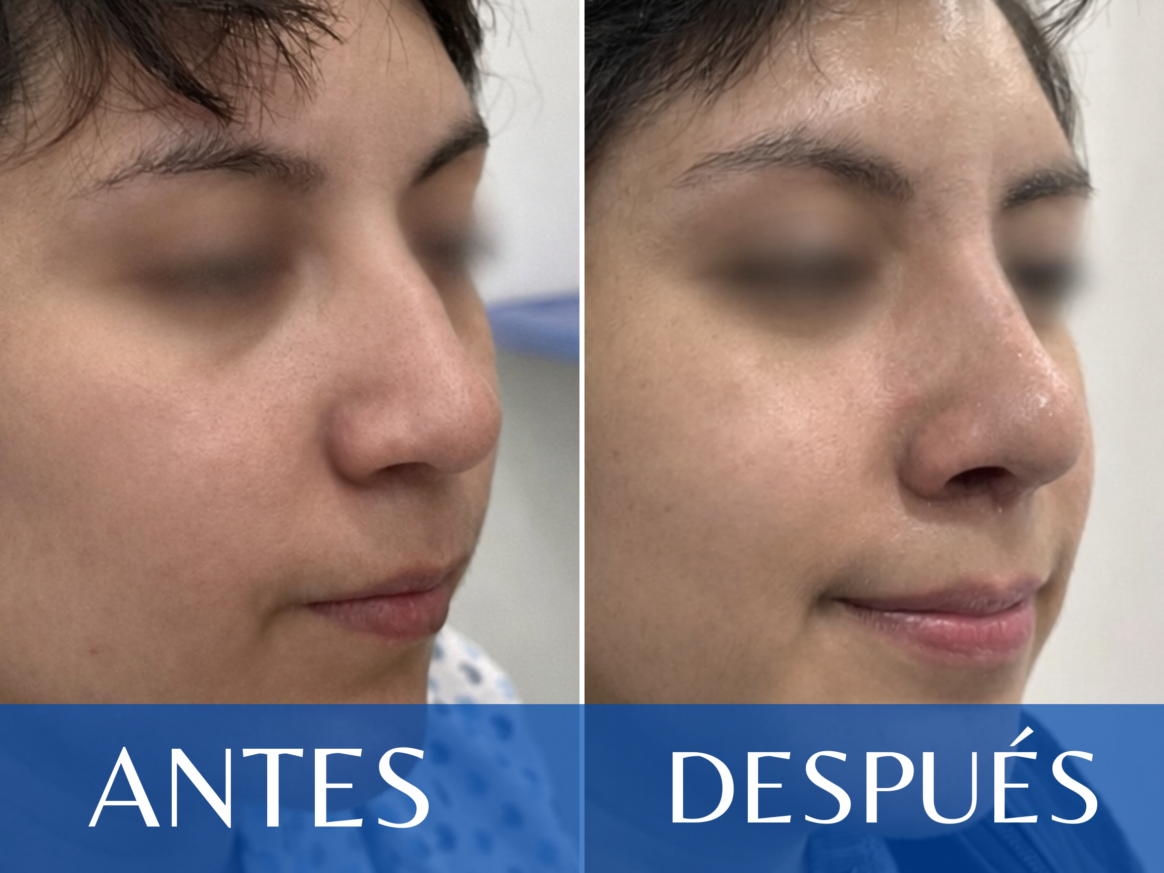 Rinoplastia antes y después - Caso 18