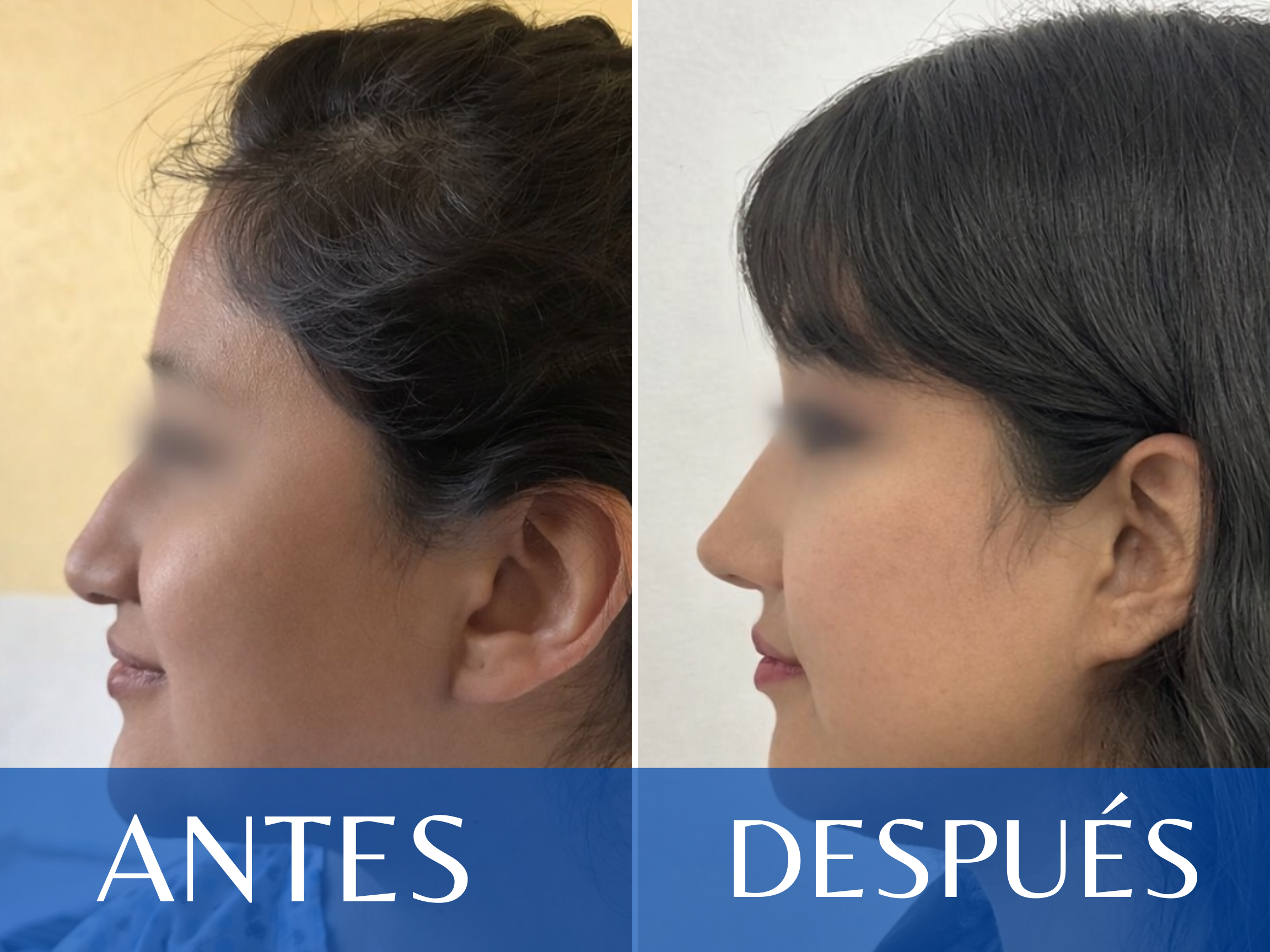 Rinoplastia antes y después - Caso 2