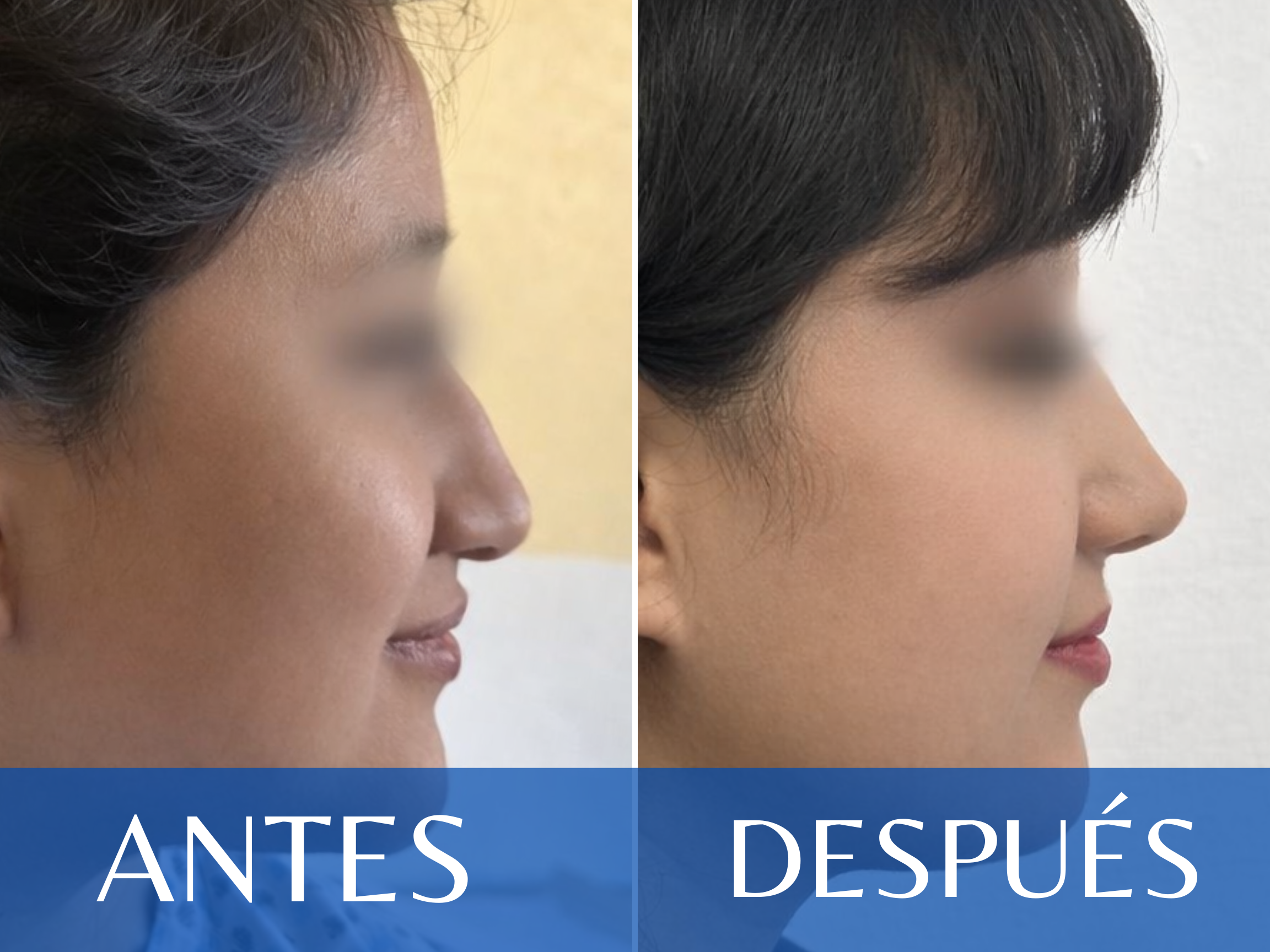 Rinoplastia antes y después - Caso 3