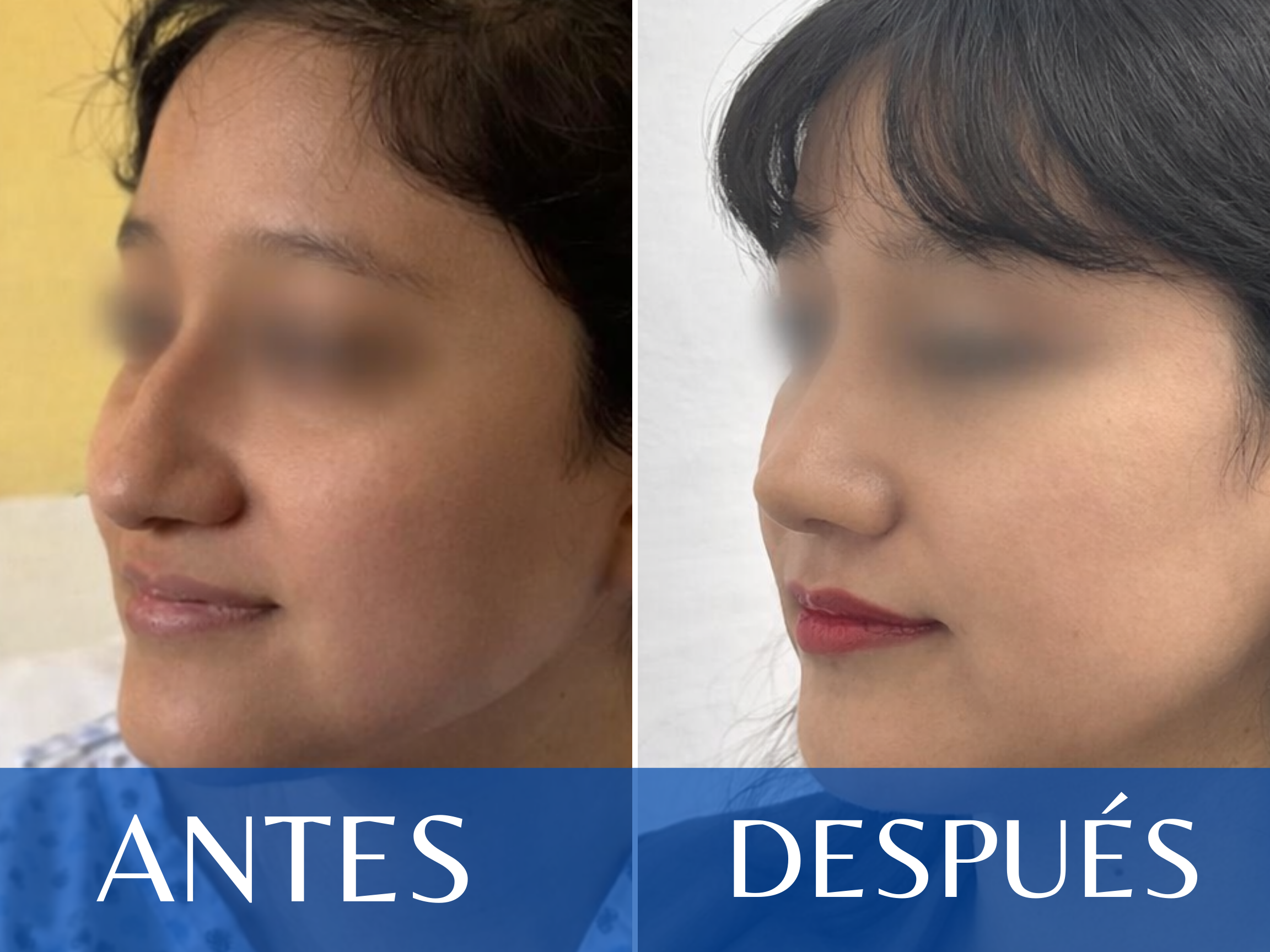 Rinoplastia antes y después - Caso 4