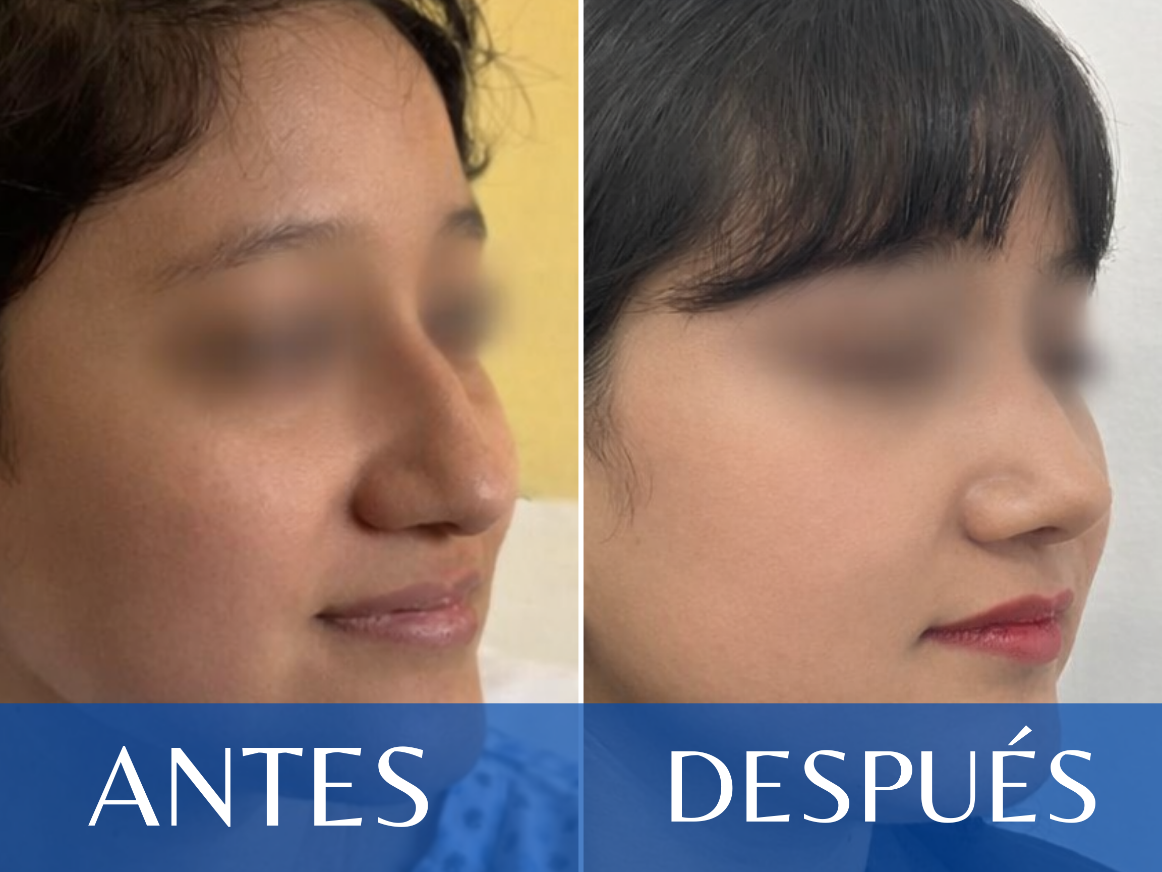 Rinoplastia antes y después - Caso 5