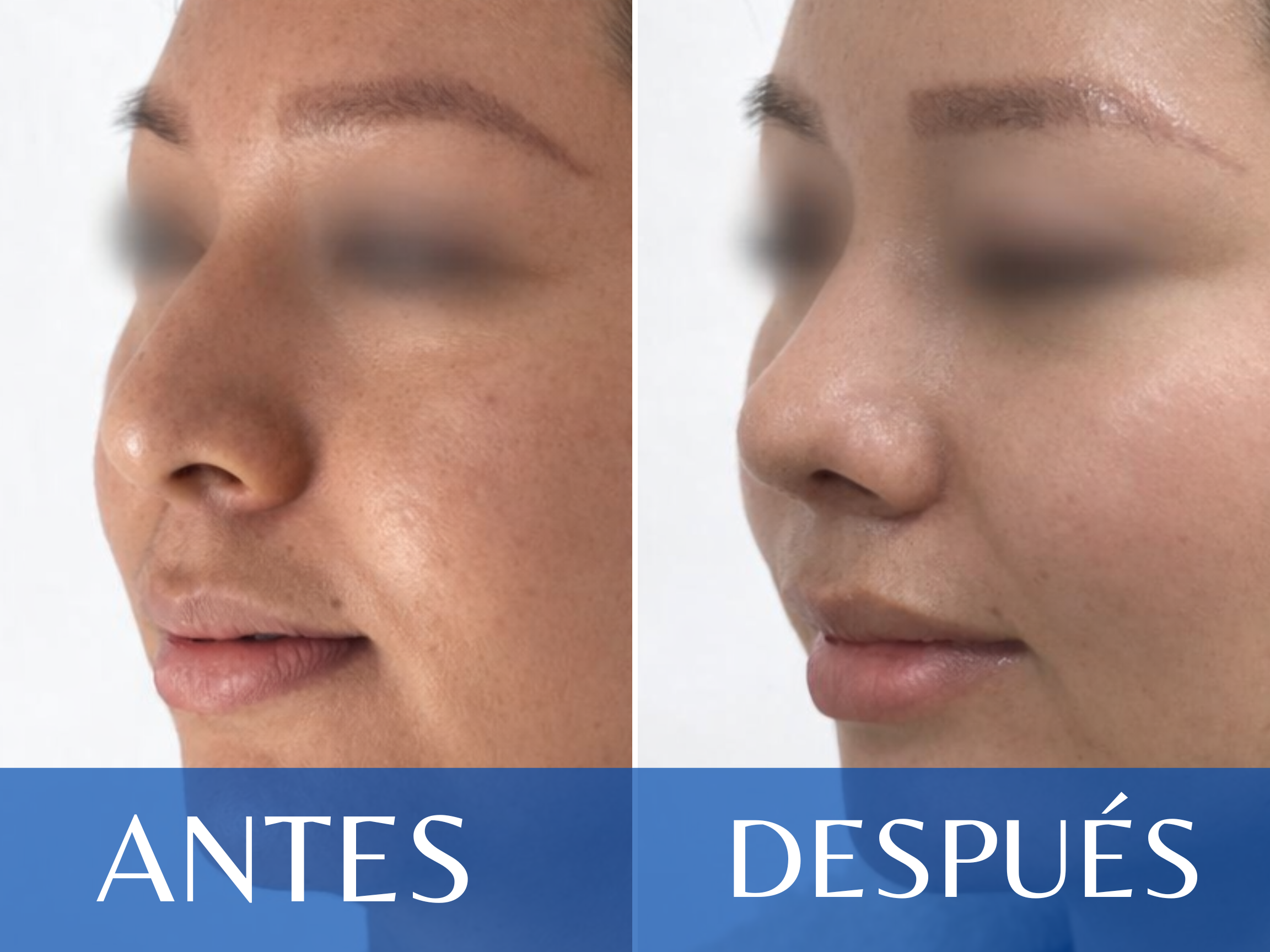 Rinoplastia antes y después - Caso 8