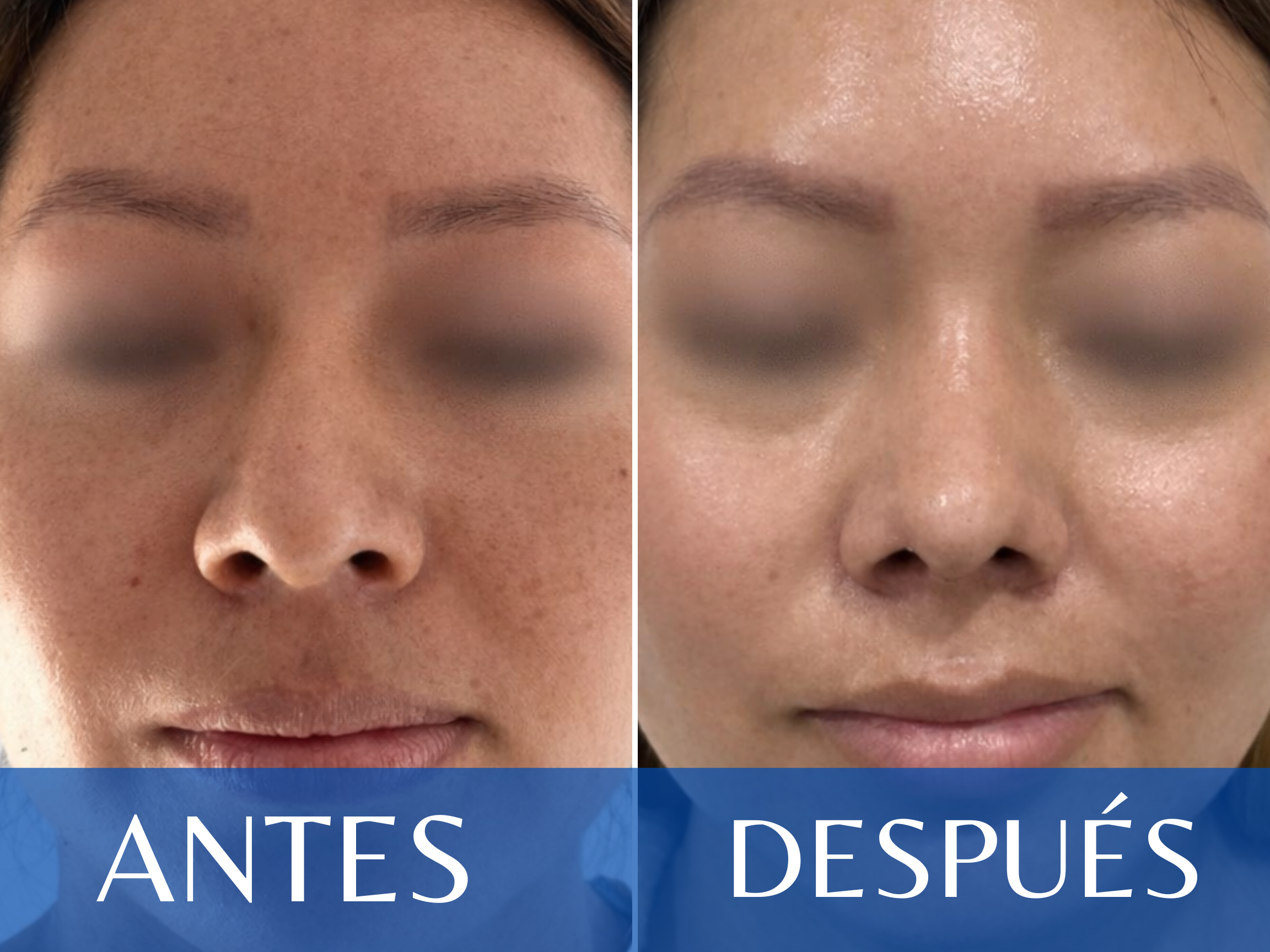Rinoplastia antes y después - Caso 9